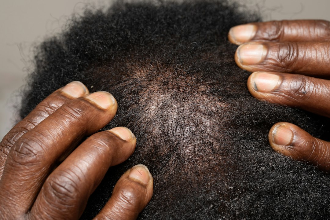 Derma Roller Hair Growth: What the Trials Actually Used